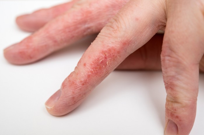 Fingers_with_Eczema