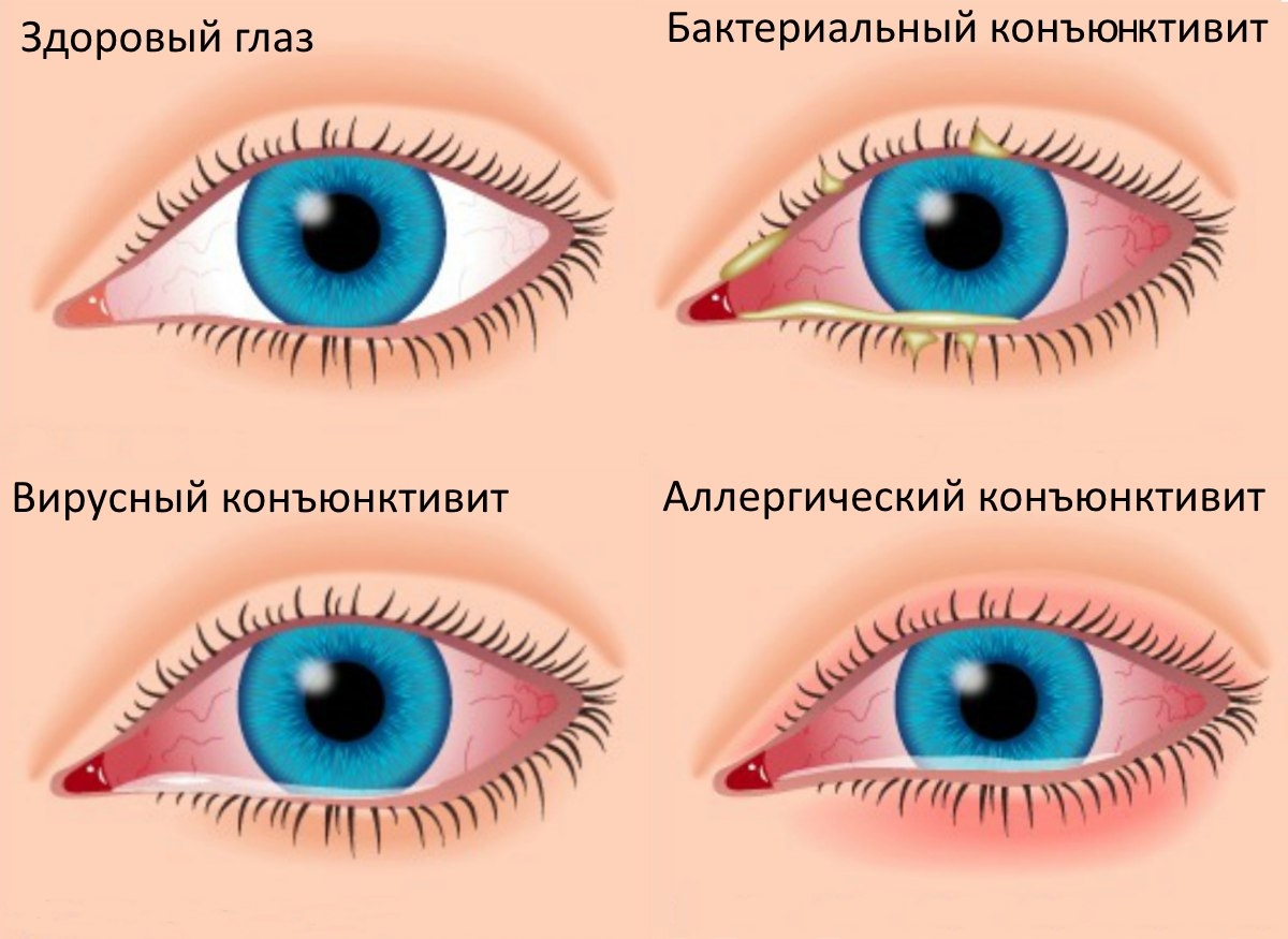 Конъюнктивит у взрослых как лечить температура Конъюнктивит у взрослых как лечить температура