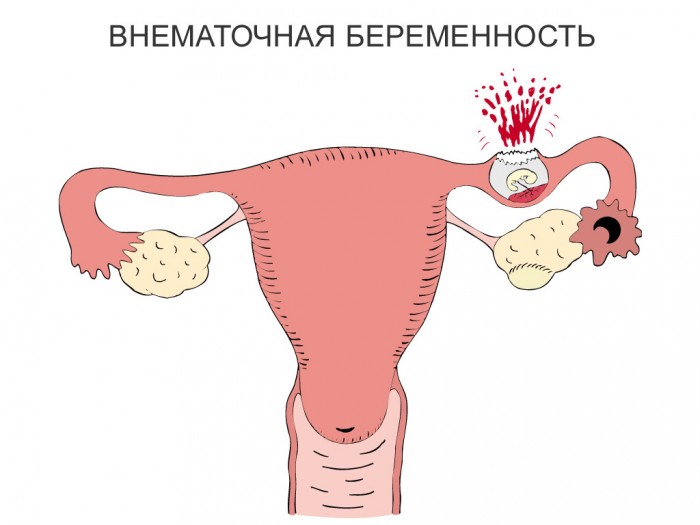 внематочная беременность