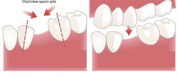 Неправильный прикус после потери зуба