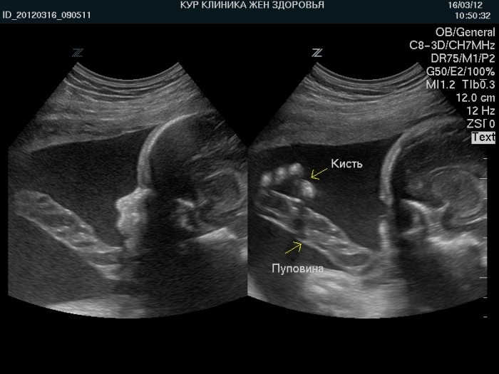 Doble cortina umbilical fetal