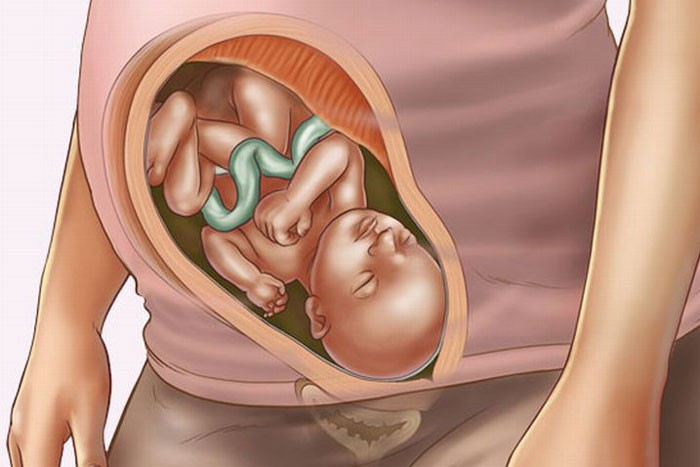 Многоводие, как правило, обнаруживают ближе к концу беременности.
