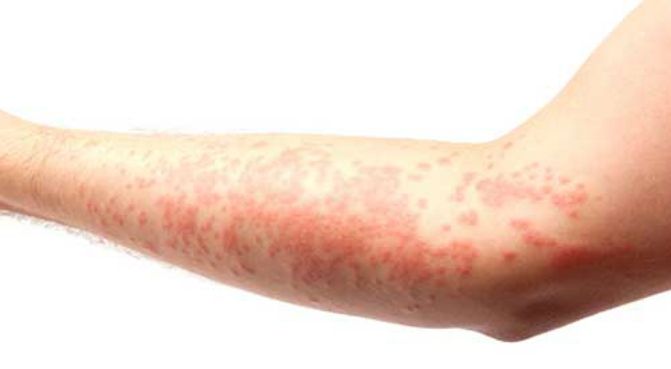 eczema-skin-rash_671