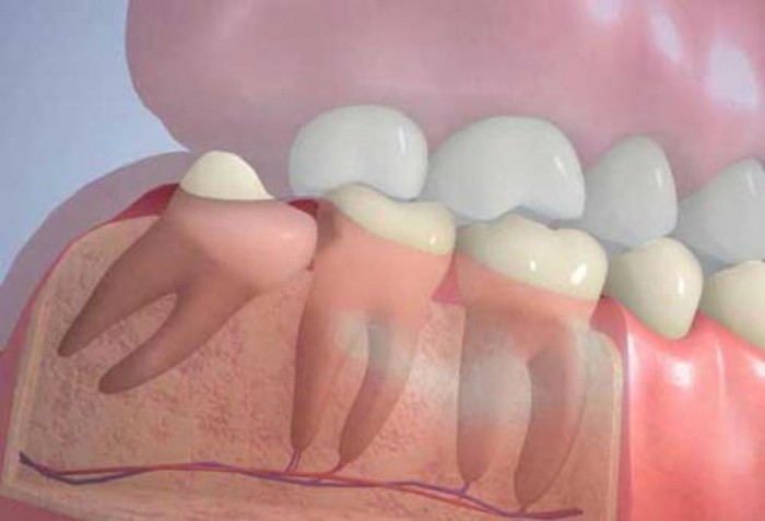 Неправильный прикус из-за роста зуба мудрости 