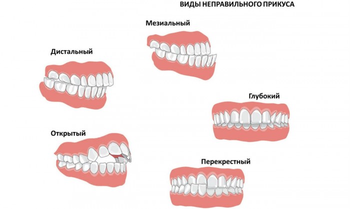 Каким бывает неправильный прикус?