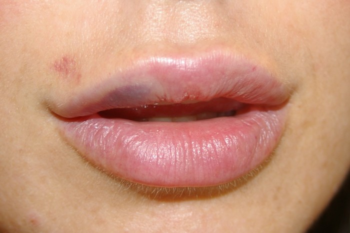 prevent-bruising-after-plastic-surgery