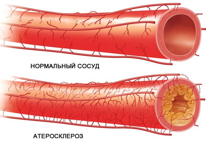 сужение сосудов мозга