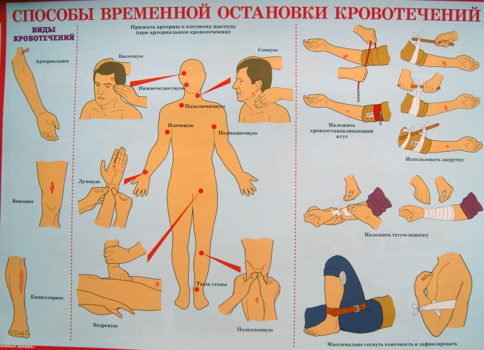 Способы временной остановки кровотечений