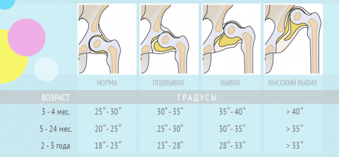 Степени дисплазии тазобедренного сустава.