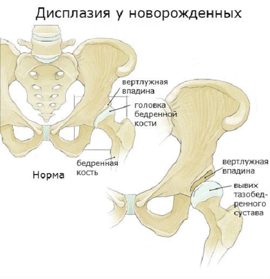 Точная причина недоразвития тазобедренного сустава у ребенка часто остается невыясненной.