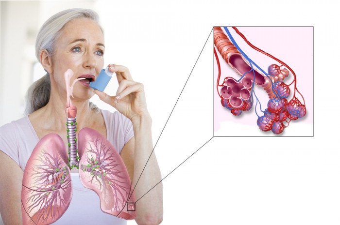 Во взрослом возрасте женщины чаще болеют астмой, чем мужчины.