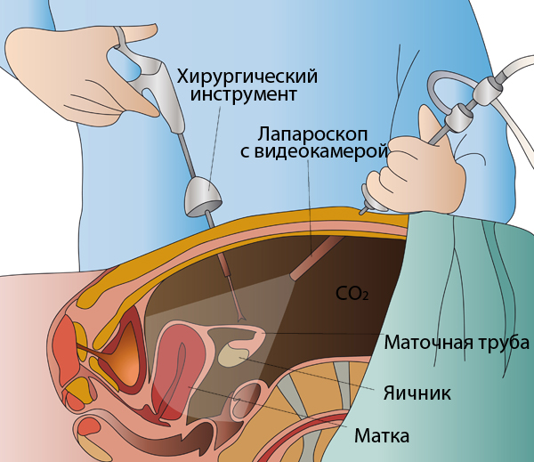 Διαγνωστική Larposcopy.