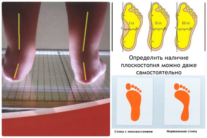 Плоскостопие у ребёнка. Какие бывают степени плоскостопия?