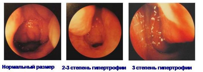 Степени аденоидов у детей.