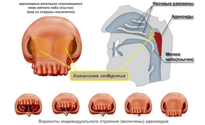 Аденоиды.