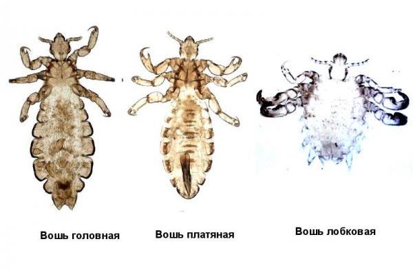 Die Arten von Läusen parasitären auf einer Person.