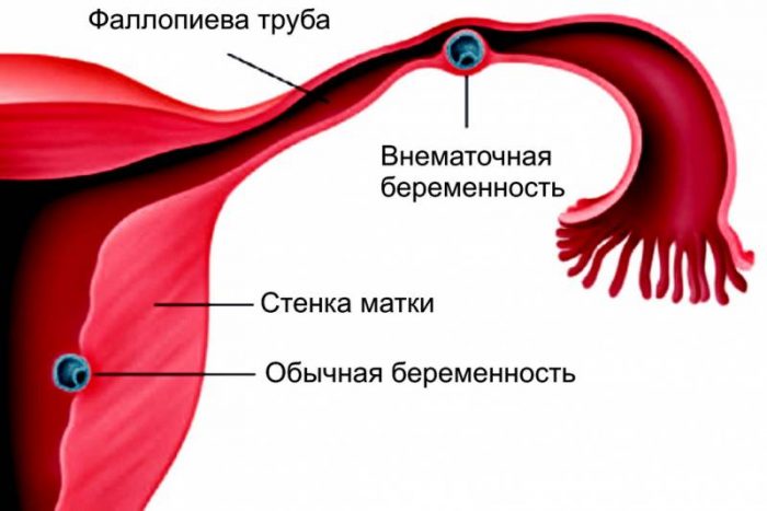 vnematochnaya-beremennost1