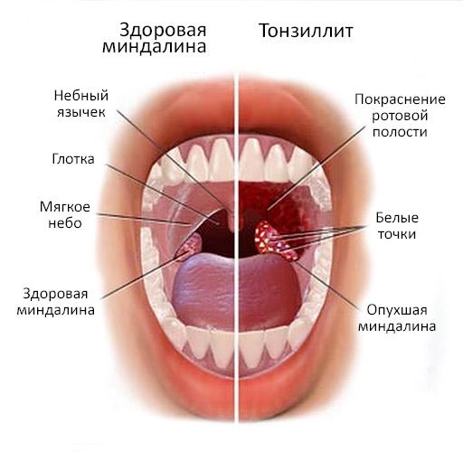 tonsillitis csatlakozása a prosztatitisben