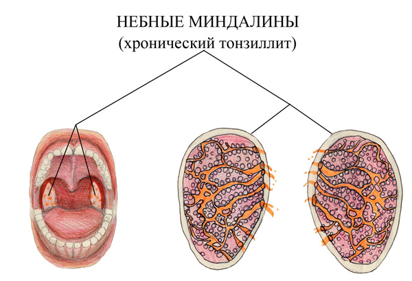 Chronic tonsillitis.