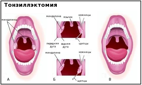 Tonsilectomie: înainte și după.