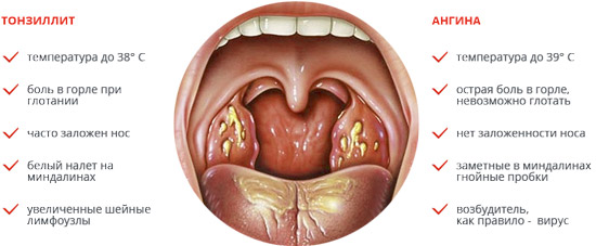 Farenjit ve tonsillit: karşılaştırma.