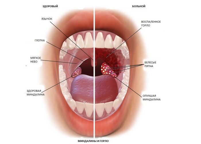 Healthy tonsils and tonsillitis.