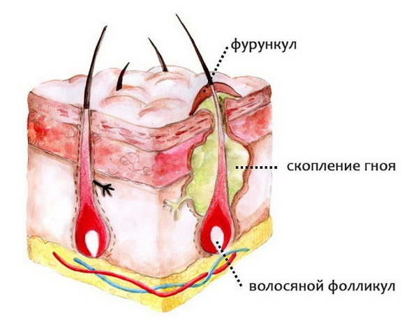 Фурункул