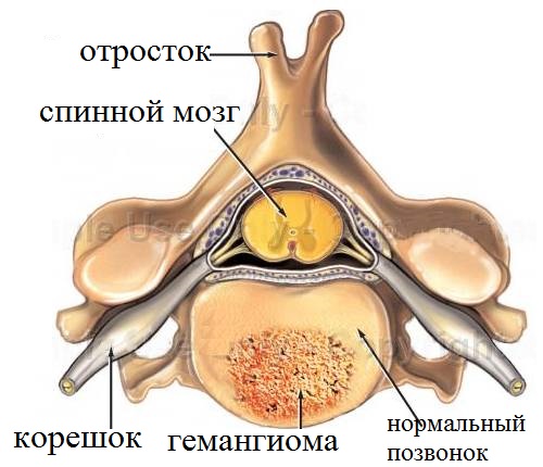 gemangioma-pozvonochnika