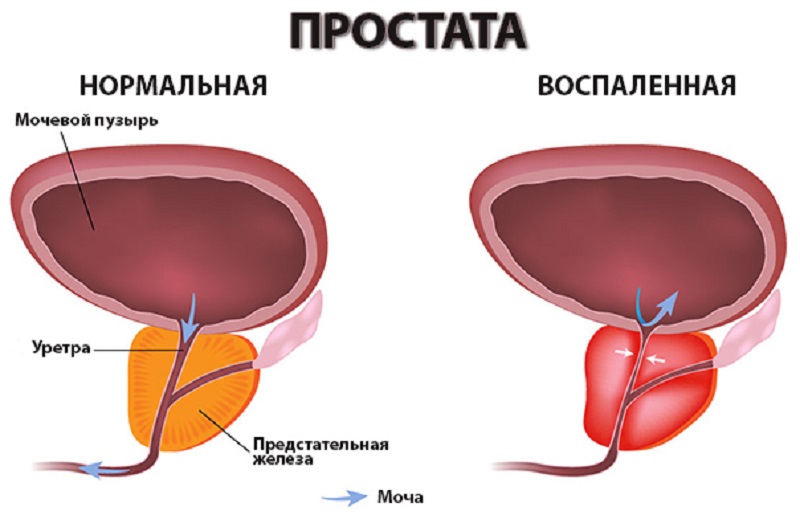 Так выглядят изменения при простатите