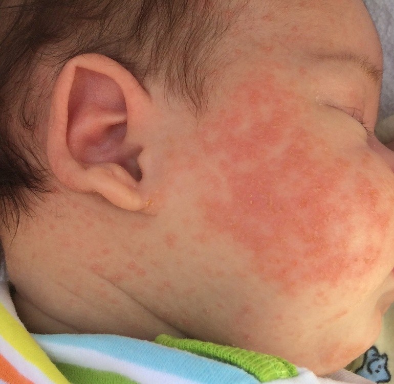 Erupción alérgica en la cara de los bebés.