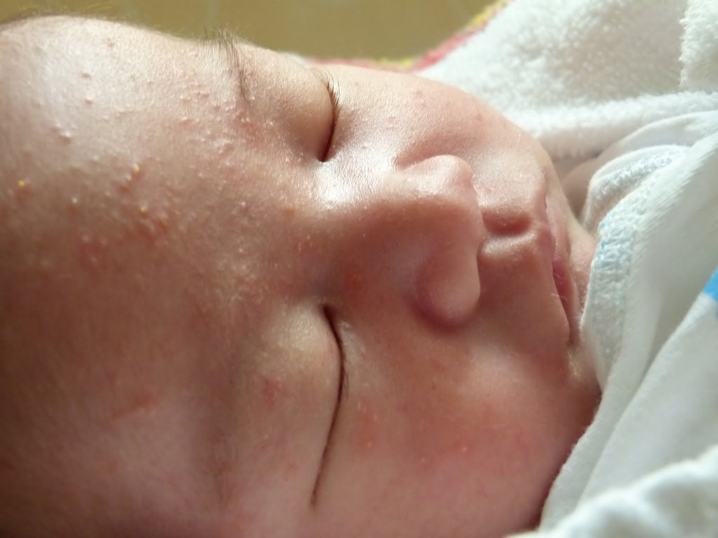 Резултати на изображението за хормонален обрив по лицето на бебета