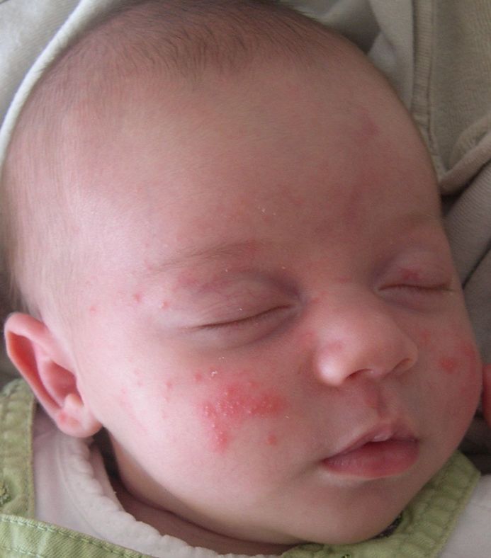 Alergia o diátesis en bebés.
