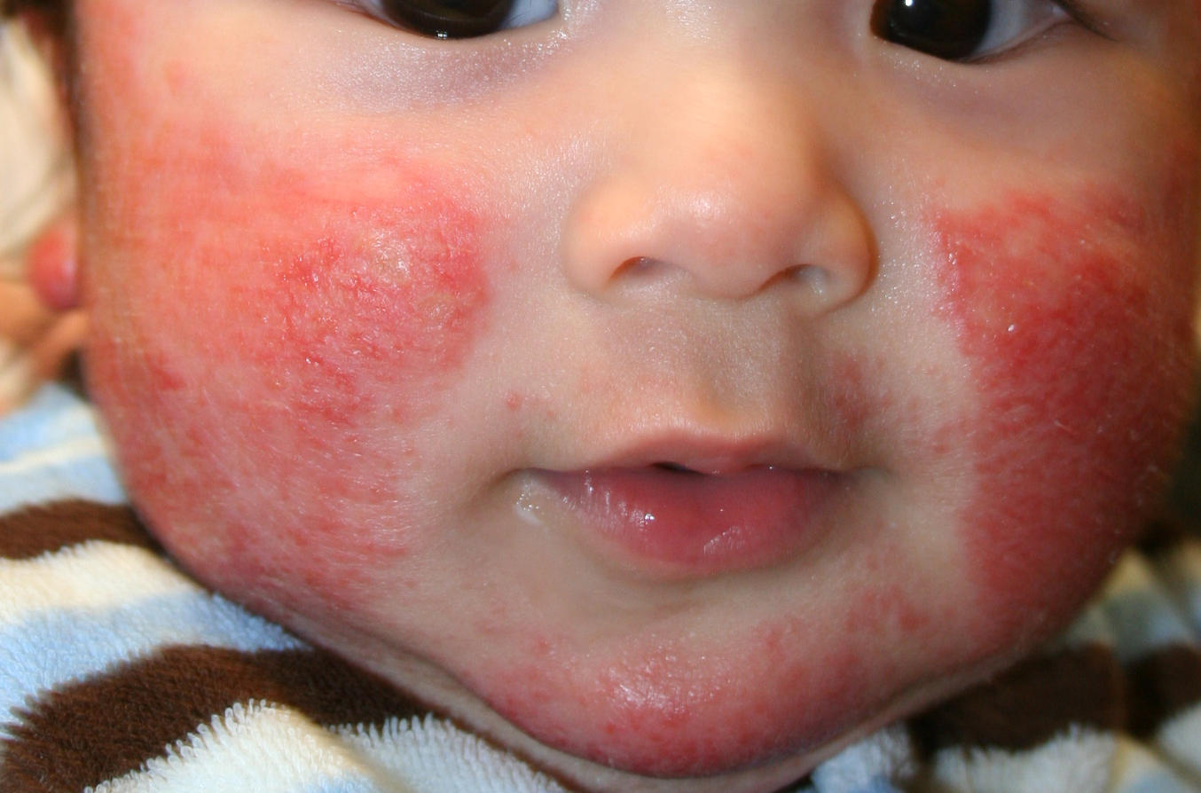 Alergická dermatitida, ekzém