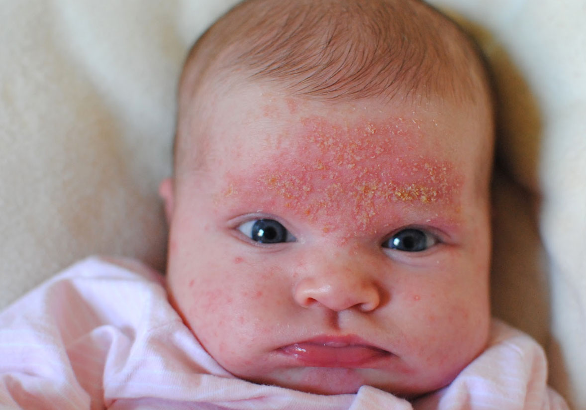 Atopische Dermatitis in Säuglingen