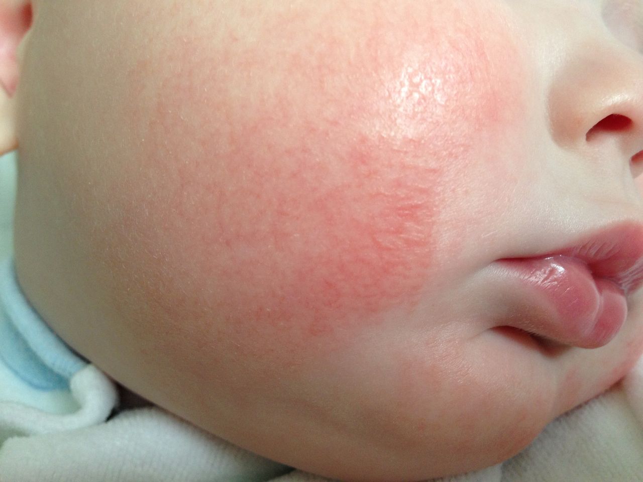 Allergic rash on the face of infants