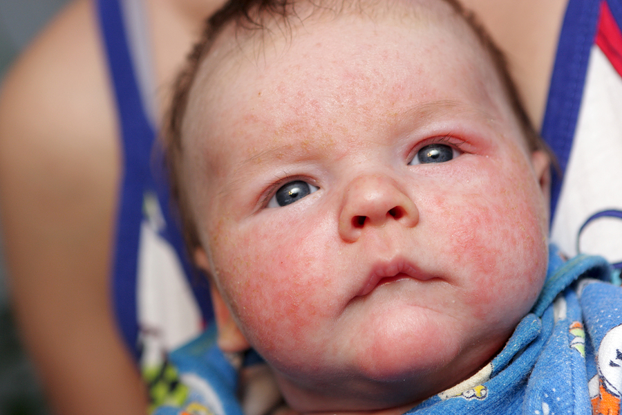 Roter Hautausschlag in Säuglingen