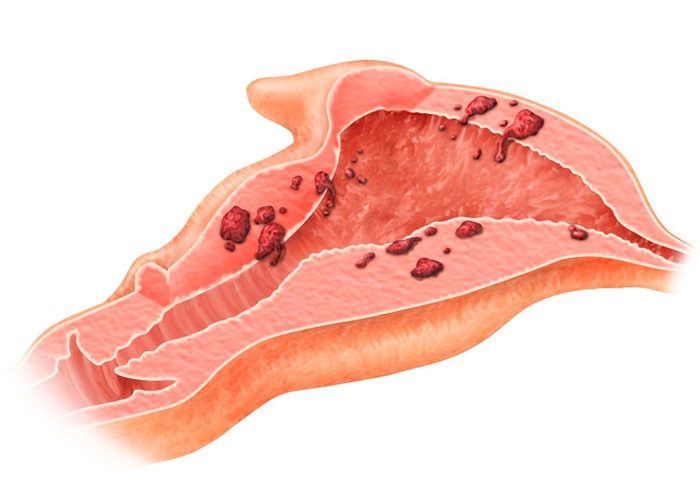 endometrioz-i-Beremennost-Mozhno-Li-Zaberemenet-PRI-Endometrioze-1