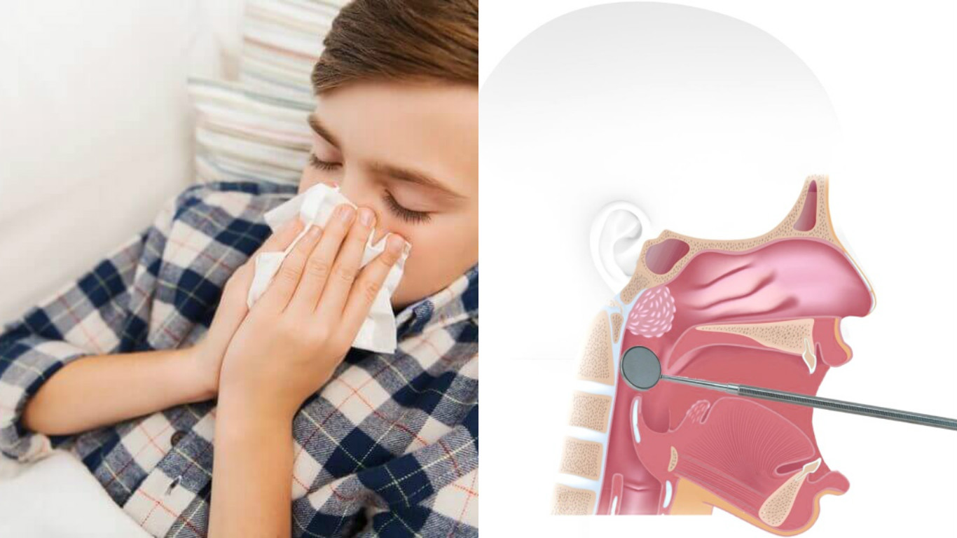 Дышит ртом соплей нет. Аденоиды у детей у детей. Заболевания носоглотки у детей.