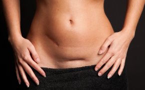 Mengapa perut setelah sesar? Cara Menghapus Perut Setelah Cesarean Bagian: Nutrisi, Persiapan Fisik, Kosmetik - Saran Spesialis
