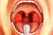 Vad är akut och kronisk tonsillit, var kommer det ifrån, som överförs än farligt, smittsamt eller inte, hur länge håller det, vilka komplikationer, konsekvenser? Hur man tvättar mandlar med tonsillit, hur man har svårt, hur man botar tonsillit gånger och för alltid?