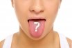 Flap in the language in adults and children - causes, treatment, prevention. How to get rid of the tongue at home?