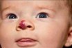 Gemangioma en niños en la cara y el cuerpo: signos, razones, tratamiento, foto, al médico para apelar. Extracción quirúrgica de hemangioma niño con láser, nitrógeno líquido: indicaciones, consecuencias, comentarios